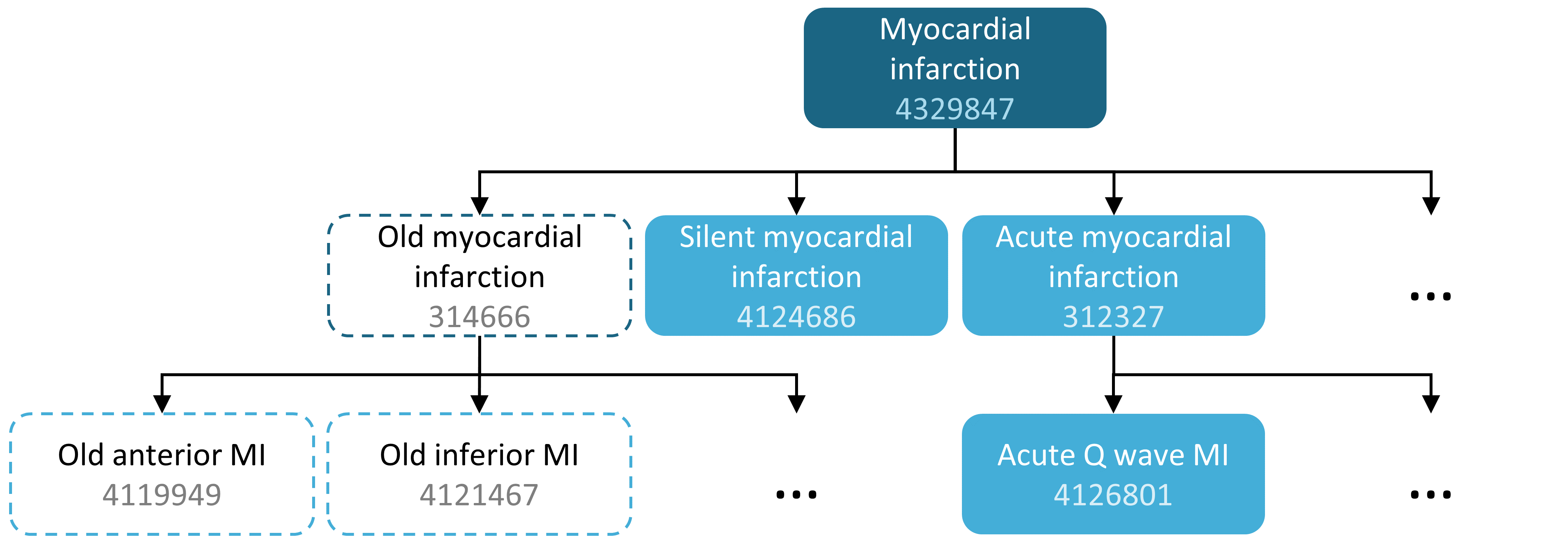 A concept set including "Myocardial infarction" (with descendants), but excluding "Old myocardial infarction" (with descendants).
